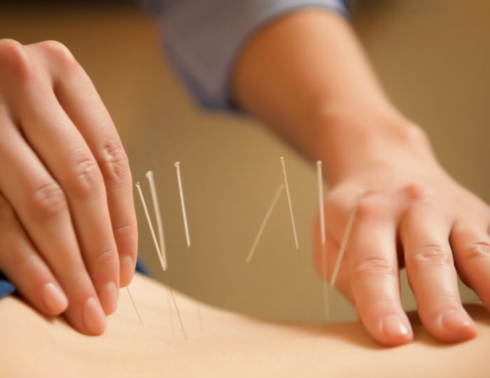 Иглорефлексотерапия - Пансионат «ФЕЯ-2 SUNBEACH RESORT»